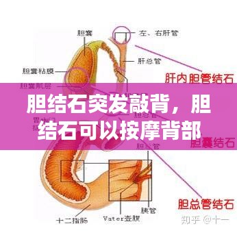 胆结石突发敲背，胆结石可以按摩背部吗 