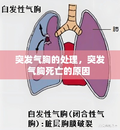 突发气胸的处理，突发气胸死亡的原因 