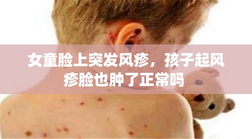 女童脸上突发风疹，孩子起风疹脸也肿了正常吗 