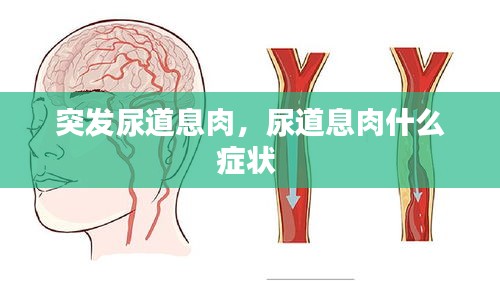 突发尿道息肉，尿道息肉什么症状 