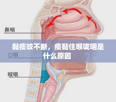 黏痰咬不断，痰黏住喉咙咽是什么原因 
