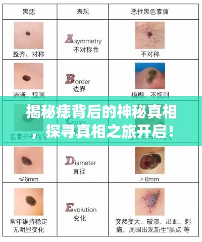 揭秘痣背后的神秘真相，探寻真相之旅开启！